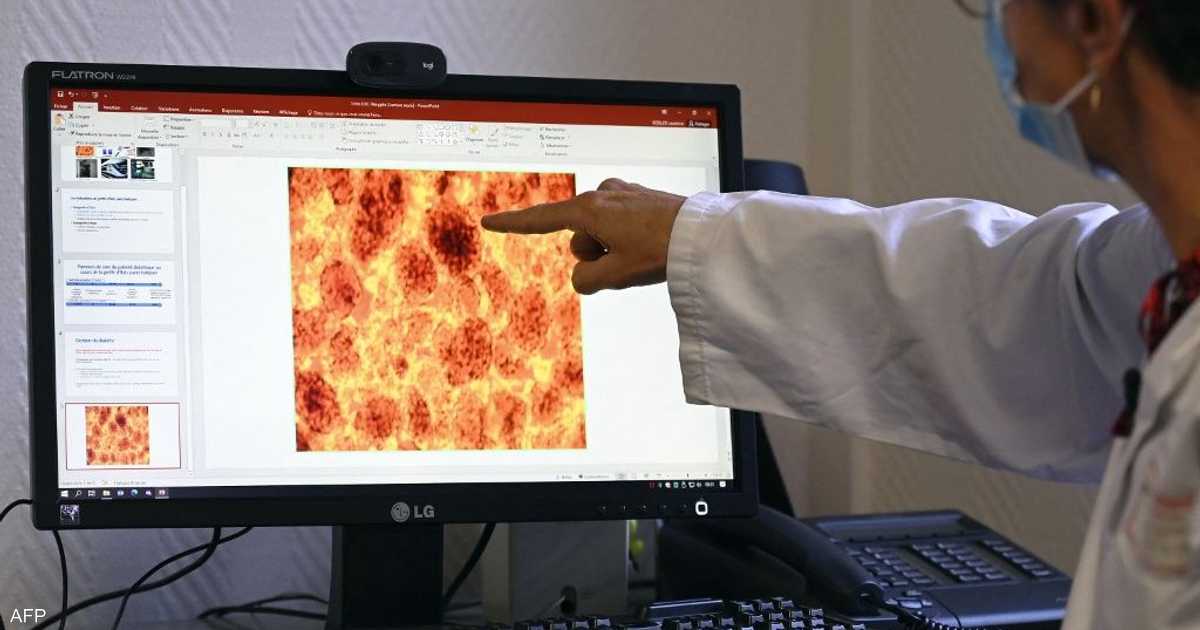 لقاح واعد لسرطان البنكرياس يحفز استجابة مناعية